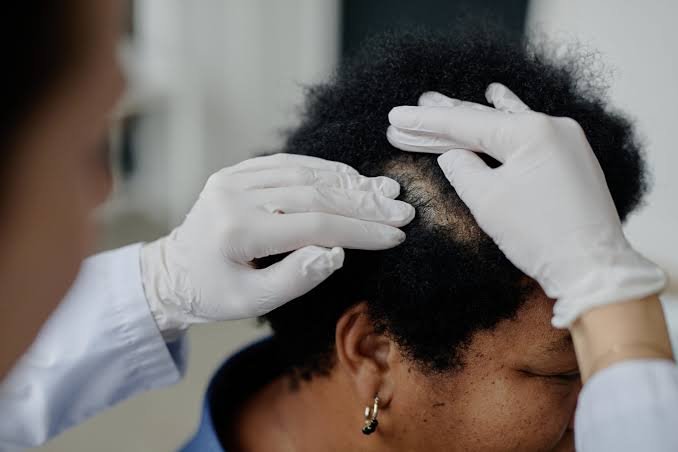 Benefits of Using Hair Loss Treatments