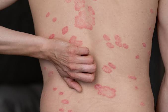 How Urgent Care Can Assist with Mild Allergic Reactions