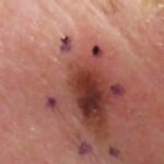 Why You Should Consult a Melanoma Dermatologist for Skin Changes