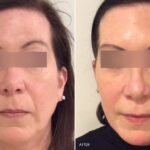 Exploring Different Types of Dermal Fillers