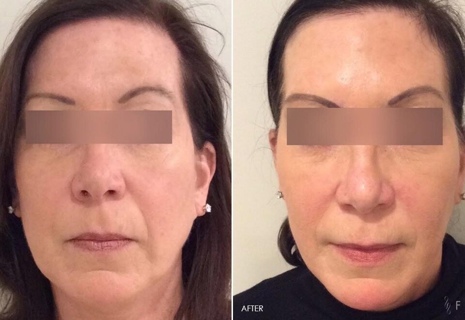 Exploring Different Types of Dermal Fillers