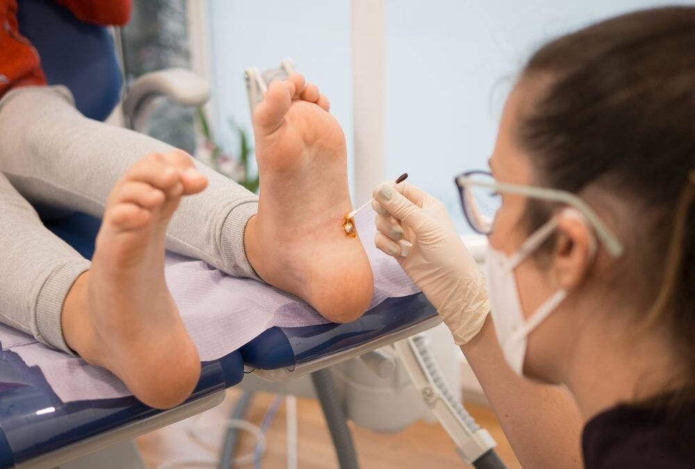 Exploring Treatments for Plantar Warts