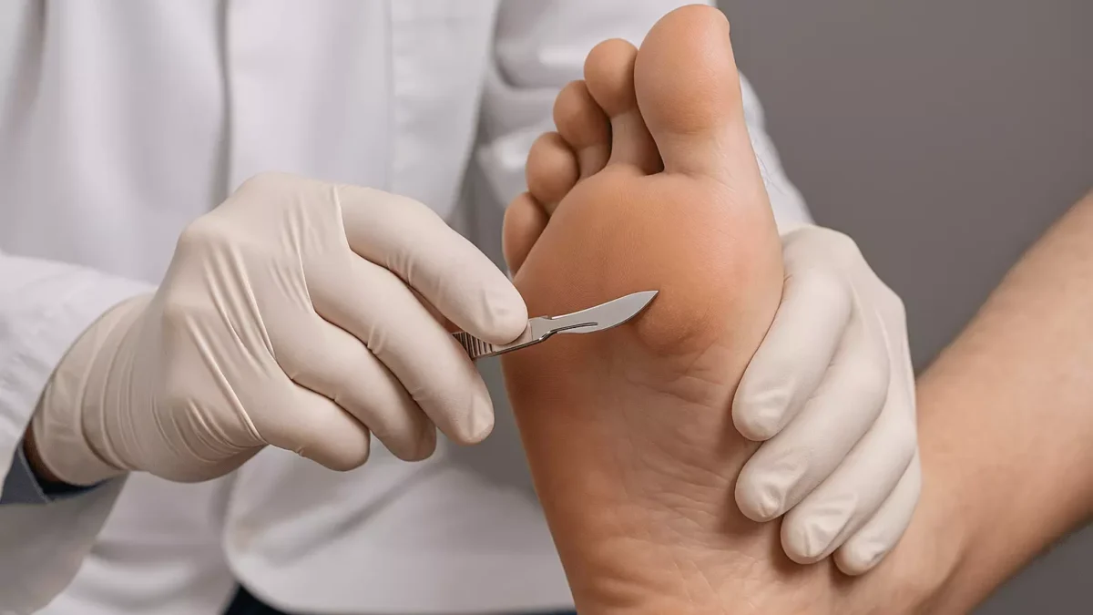 Recognizing the Relationship Between Plantar Warts and Foot Hygiene